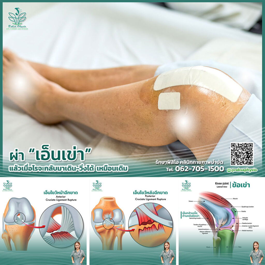 ผ่าเอ็นเข่า